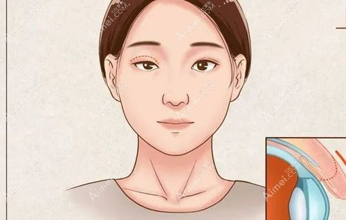 沈阳杏林张莹莹做双眼皮怎么样 沈阳杏林张莹莹做双眼皮怎么样