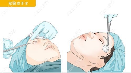 方涛修复双眼皮怎么样