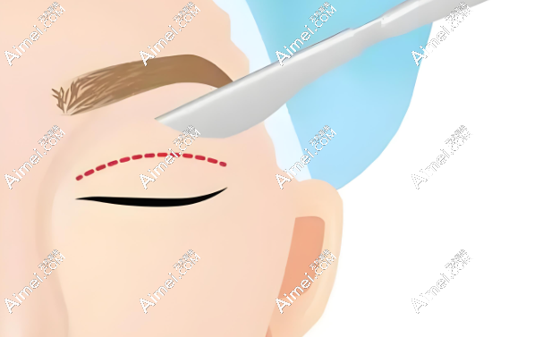 眼部整形