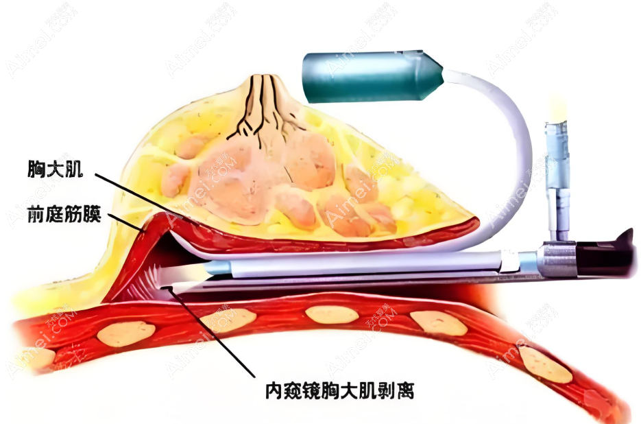 成都米兰柏羽隆胸真的使用内窥镜