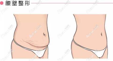 天吶！廣州麗合肖添有腹壁成形術(shù)技術(shù)絕了，不愧是國內(nèi)腹壁成形界的實力派醫(yī)生