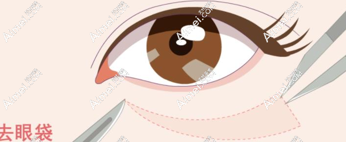 西安叶子医疗美容医院徐佳明简介:不开刀去眼袋超火!实践测评后真觉得...