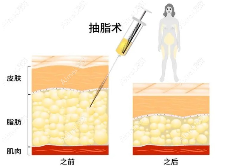 赵军舰吸脂收费不贵成效好