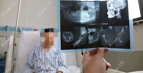 李献和磨骨怎么样靠谱吗？靠谱！亲测李献和轮廓做的好尤其擅长下颌角磨骨手术