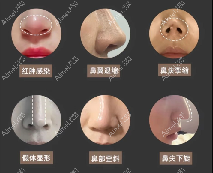 成都鼻整形周柯坐镇大象致颜，做鼻修复口碑评价收割机！do鼻收费贵到“肉疼”却劝退不了排队的人！