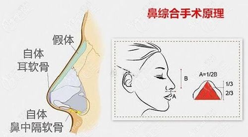 沃尔冯雁平隆鼻口碑如何