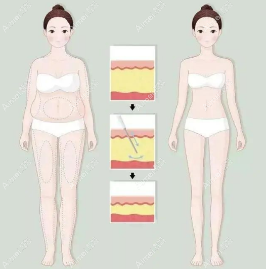 3S人鱼体雕真不是骗局，结果有目共睹