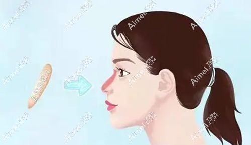 我的7万肋骨膨体鼻综合经历