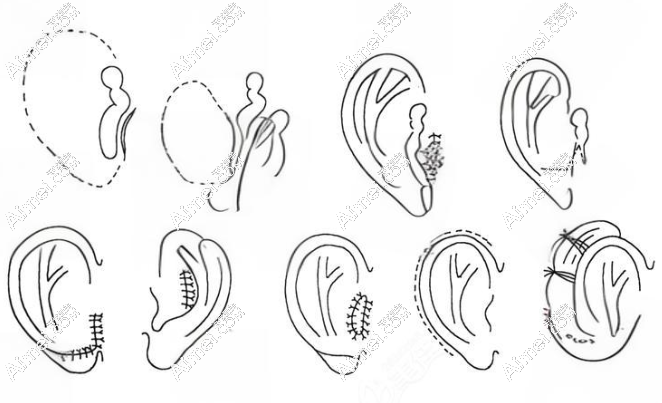 【廣州余文林預(yù)約入口】耳垂裂|小耳畸形|隱形耳矯正24小時在線預(yù)約