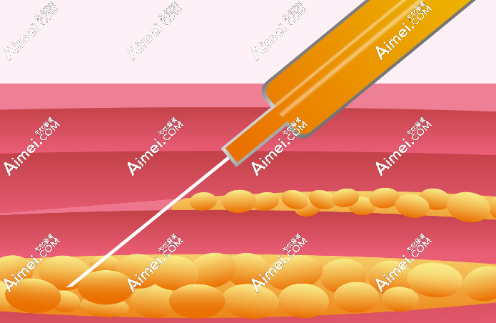 孙泽芳医生做大腿吸脂与面部脂肪填充的优势
