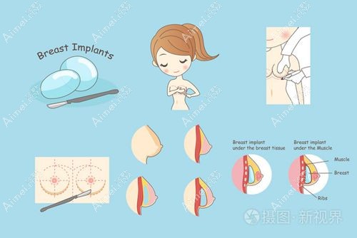 陈德法丰胸失败实例有吗 陈德法丰胸失败实例有吗