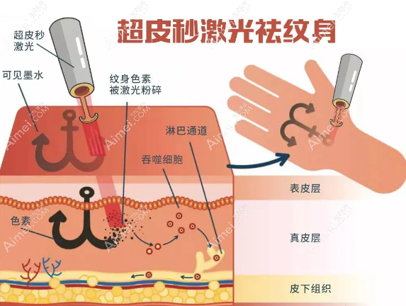 2025深圳洗紋身好的醫(yī)院排名榜，推薦鵬程、美萊等做皮秒激光洗紋身好的正規(guī)醫(yī)院