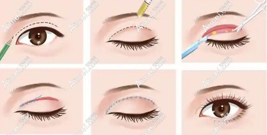 吕方中双眼皮修复收费透明