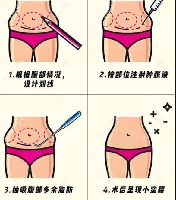 深圳钟伟洪抽脂价目表 深圳钟伟洪抽脂价目表