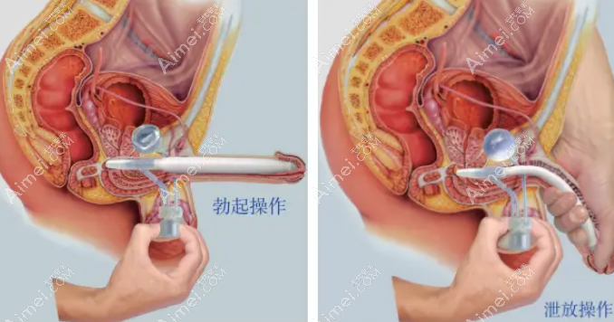 李世荣男性生殖整形实例疗效好