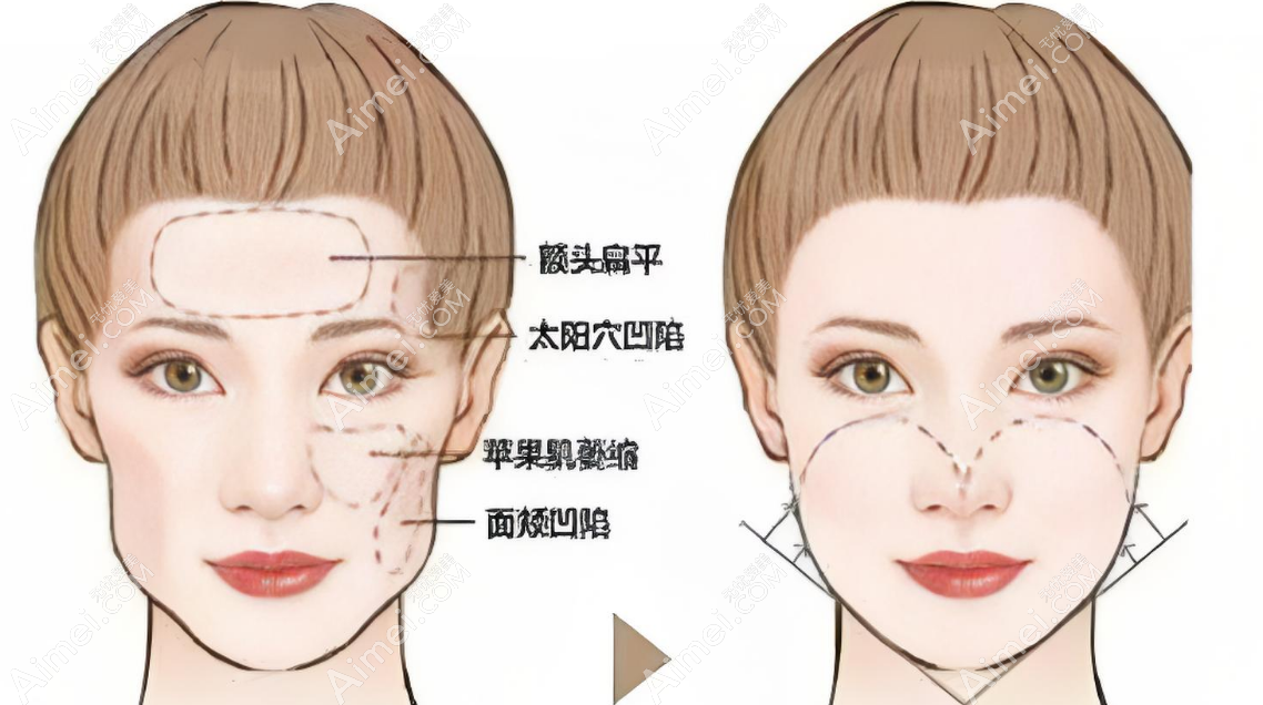 王明利脂肪填充对比