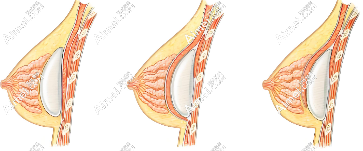 杭州万连壮隆胸价格合理 杭州万连壮隆胸价格合理