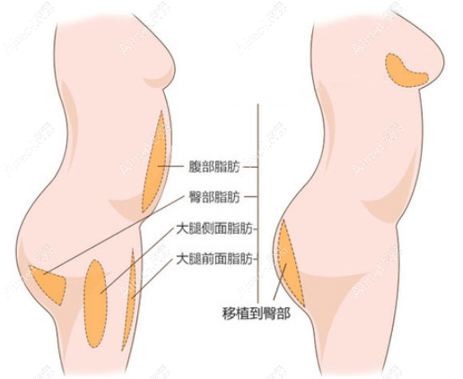 北京华韩医院余恩旭隆臀实例