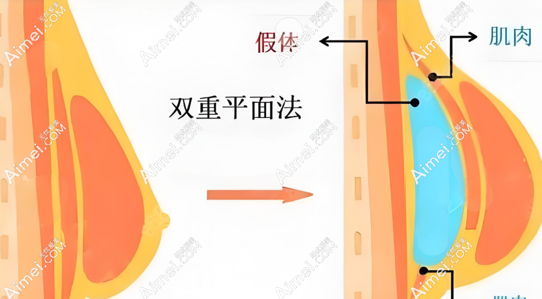 杭州万连壮隆胸真人实测 杭州万连壮隆胸真人实测