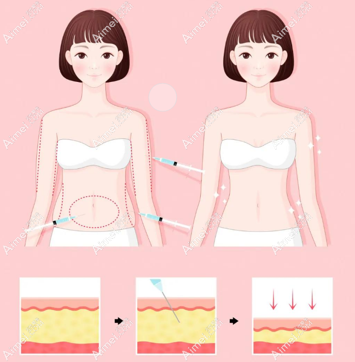 趙軍艦吸脂價(jià)格