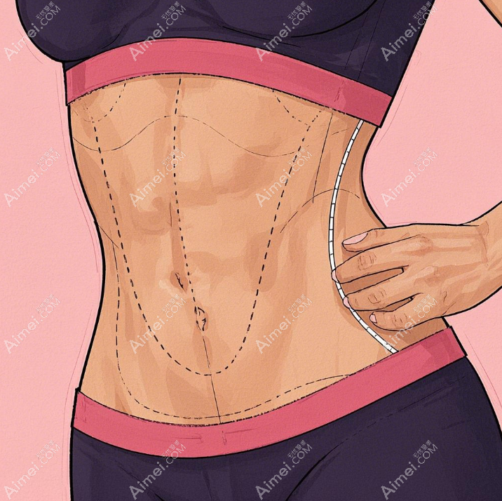 腹壁整形www.aimei.com