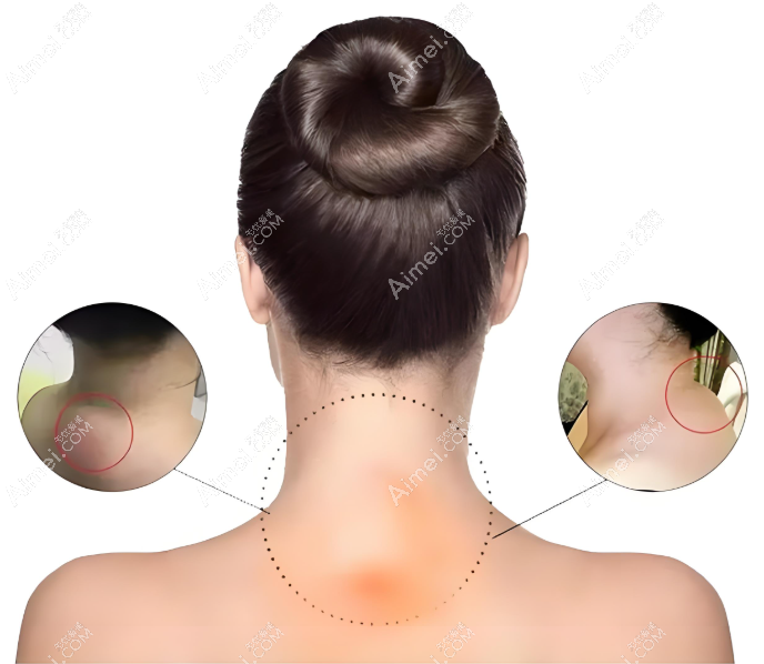 黄学峰一针去富贵包的真实病例