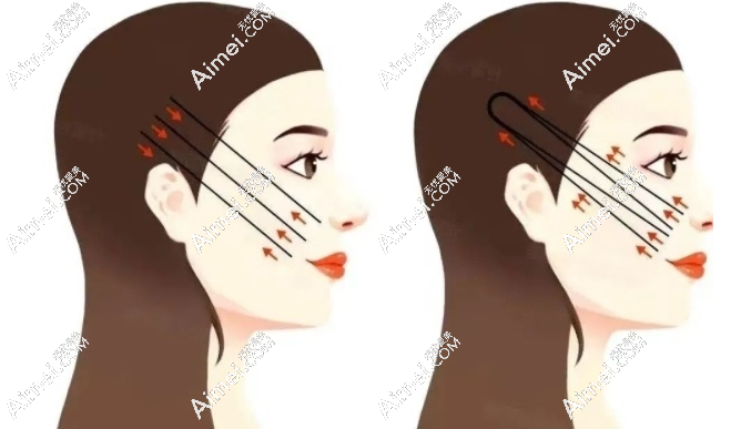 成都刘远程筋膜提升实例 成都刘远程筋膜提升实例