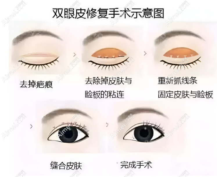 北京张冰洁修复双眼皮怎么样