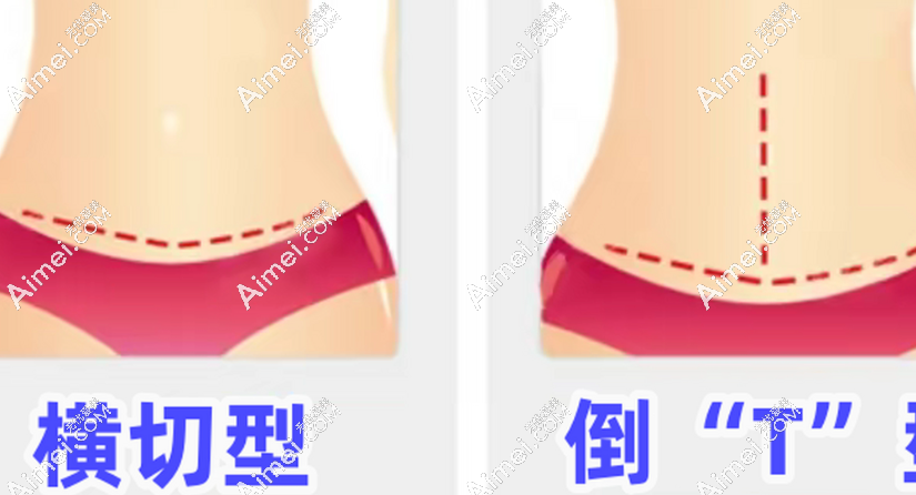 崔鑫医生做腹壁整形技术硬核