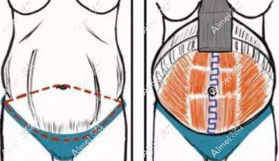 崔鑫医生个人简历：做腹壁整形和隆胸技术靠谱