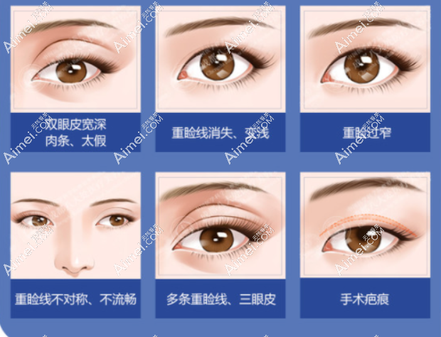 北京双眼皮修复价格便宜的医生是谁