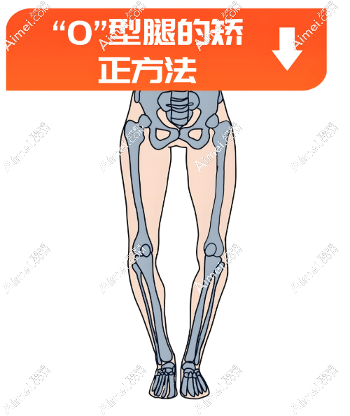 李沁奕做腿型矫正 李沁奕做腿型矫正