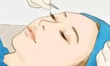 北京常冬青修复双眼皮技术优势