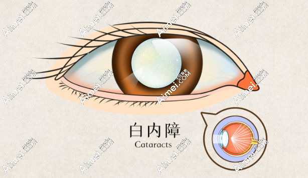 保定鷹華眼科醫(yī)院葉子隆醫(yī)生怎么樣