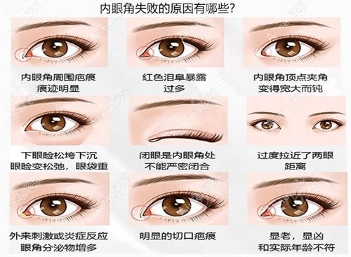 魏志香和張冰潔哪個修復(fù)內(nèi)眼角好？高難度修復(fù)技術(shù)、口碑大 PK！附術(shù)后自然度評分