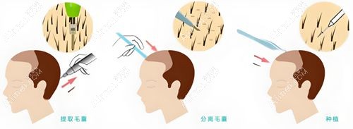 男士發(fā)際線種植國內植發(fā)醫(yī)院價格對比