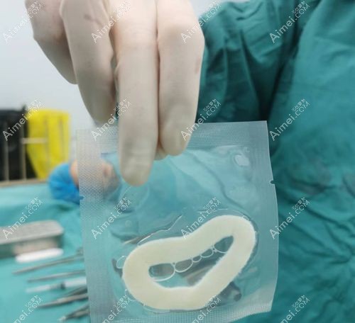 5d 生物束带紧缩术深度测评