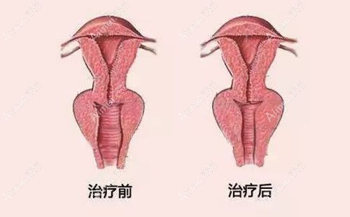 有5d生物束帶嗎？緊縮術(shù)成效、維持年限深度測評，價格與3d束帶誰更值得選