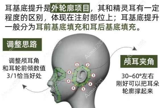 耳基底提升打什么牌子的玻尿酸好?乔雅登/瑞蓝/艾莉薇硬核测评!强支撑+1年持久