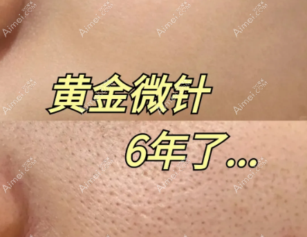 黄金微针