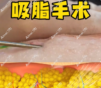 吸脂手术 吸脂手术