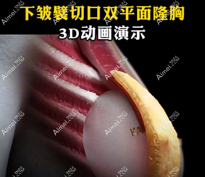 梦萦假体motiva和星熠璀璨价格差不多,但性能差远了(梦萦6代不影响哺乳,躺下流动散开,超自然)