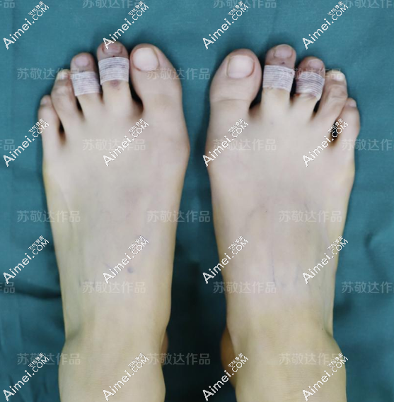 北京圣嘉新大脚骨矫正医院脚趾缩短后的样子