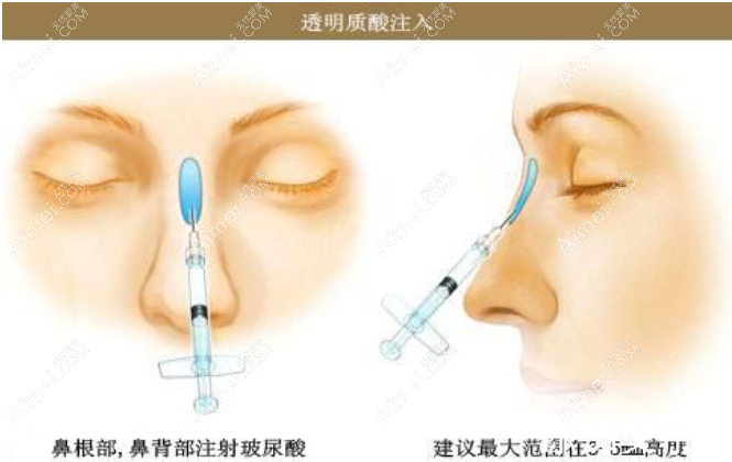 注射隆鼻