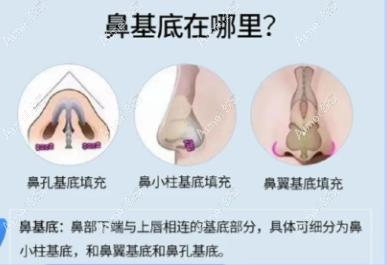 鼻基底填充