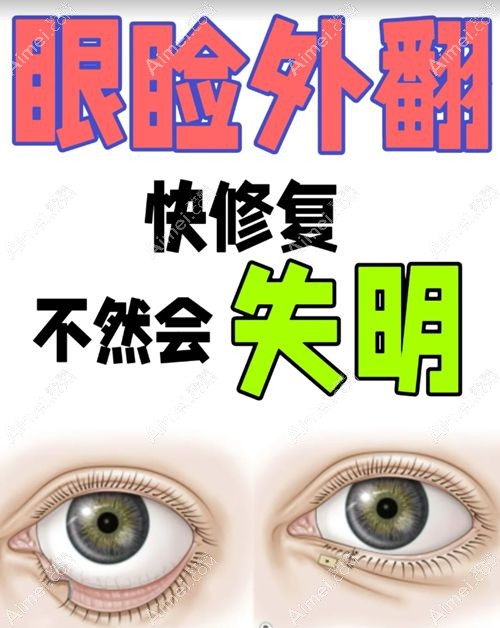 杜园园修复下眼皮外翻技术好，是杜园园亲自手术失败实例没有费用4.8万起