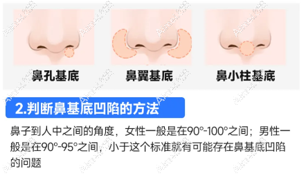 鼻基底填充