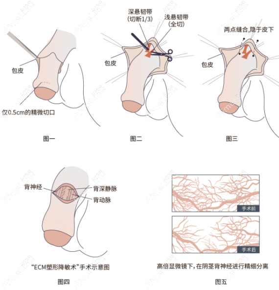李世荣生殖器整形实例多，阴茎延长真人对比从7-13cm/增粗+4cm