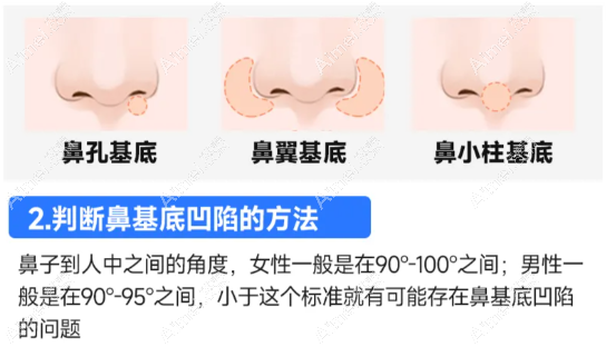 鼻基底填充 鼻基底填充