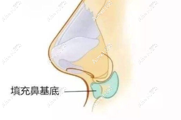 鼻基底填充 鼻基底填充